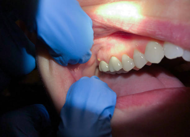 Best Broken or Chipped Tooth Repair in Newport, KY